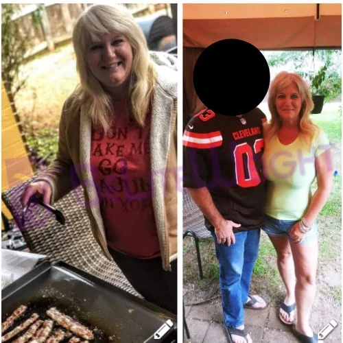 Lap Band to RNY Bypass Revision